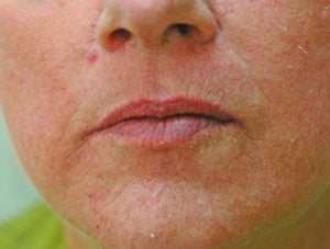 Restylane lip injections 