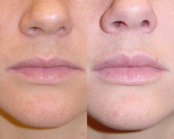 Restylane