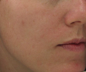Hyperpigmentation treated with Obagi for 3 months