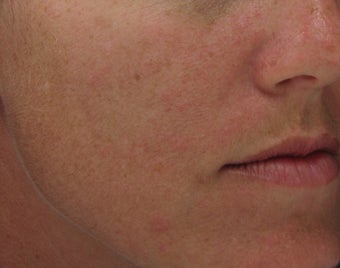 Hyperpigmentation treated with Obagi for 3 months
