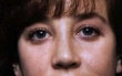 Rhinoplasty revision