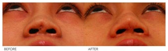 Asian Rhinoplasty