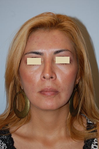 Revision Rhinoplasty