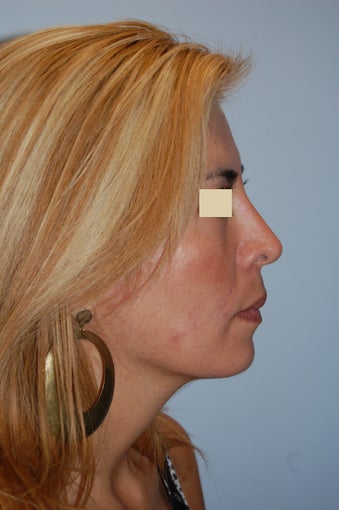 Revision Rhinoplasty 