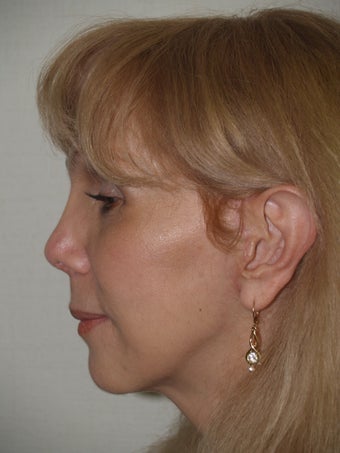 Revision rhinoplasty