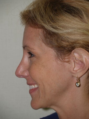 Revision Rhinoplasty