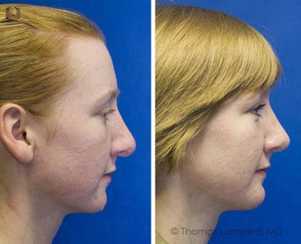 Revision Rhinoplasty, Chin Implantation, Mole Excision