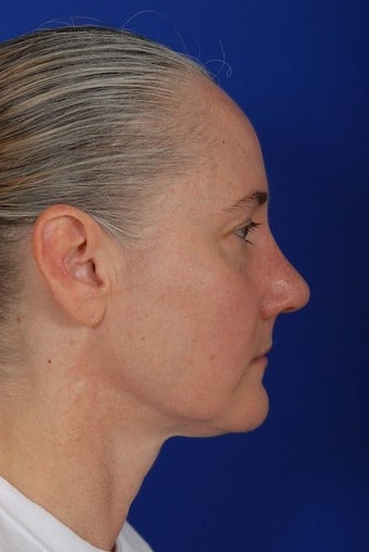 Revision Rhinoplasty