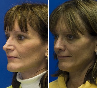 Revision Rhinoplasty