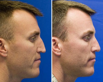 Revision Rhinoplasty with Rib cartilage graft