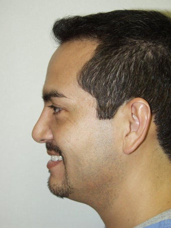 Revision Rhinoplasty