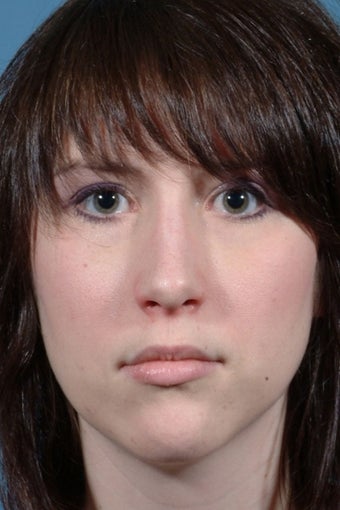 Revision Rhinoplasty