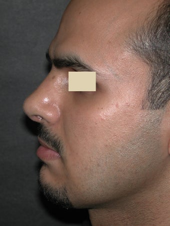 Revision Rhinoplasty