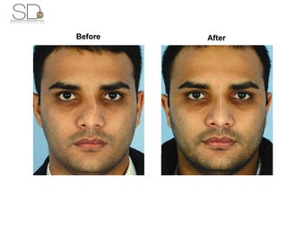 Revision Rhinoplasty 