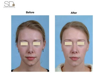 Revision Rhinoplasty