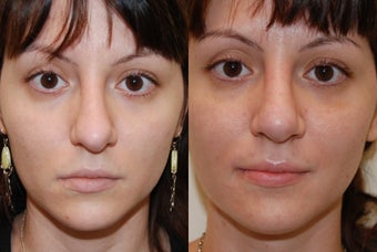 Revision Rhinoplasty