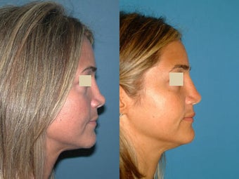 Revision Rhinoplasty