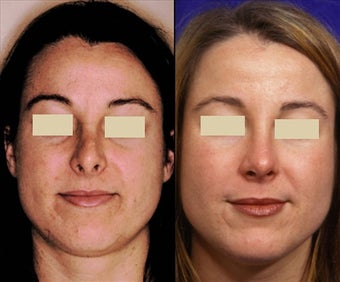 Revision Rhinoplasty