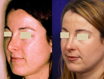 Revision Rhinoplasty