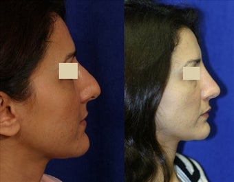 Revision Rhinoplasty