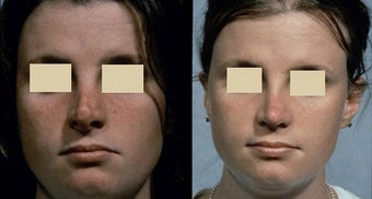 Revision Rhinoplasty