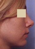 Rhinoplasty revision