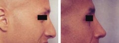 Rhinoplasty revision