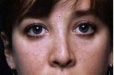 Rhinoplasty revision