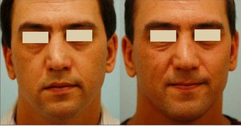 Revision/Corrective Rhinoplasty