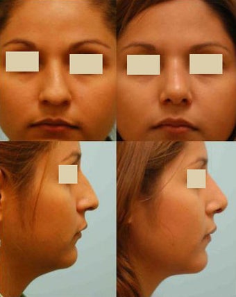 Revision/Corrective Rhinoplasty