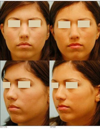 Revision/Corrective Rhinoplasty