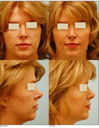 Revision/Corrective Rhinoplasty