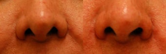 Revision/Corrective Rhinoplasty