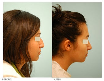 Revision/Corrective Rhinoplasty