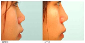 Asian Rhinoplasty