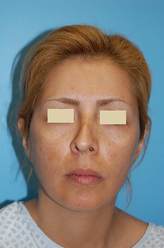 Revision Rhinoplasty