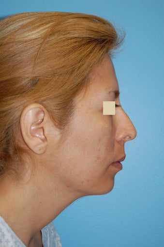 Revision Rhinoplasty 