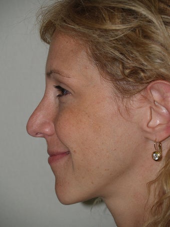 Revision Rhinoplasty
