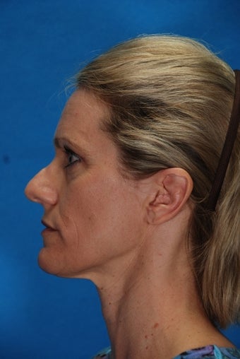 Revision Rhinoplasty