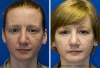 Revision Rhinoplasty, Chin Implantation, Mole Excision