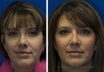 Revision Rhinoplasty