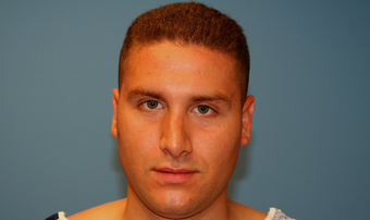 Revision Rhinoplasty