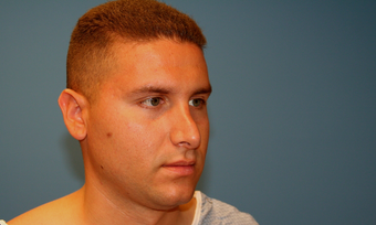 Revision Rhinoplasty