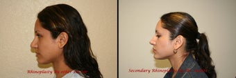 Revision Rhinoplasty