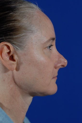 Revision Rhinoplasty