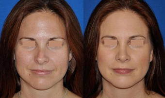 Revision Rhinoplasty