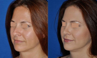 Revision Rhinoplasty