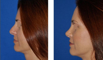 Revision Rhinoplasty