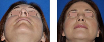 Revision Rhinoplasty
