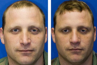 Revision Rhinoplasty